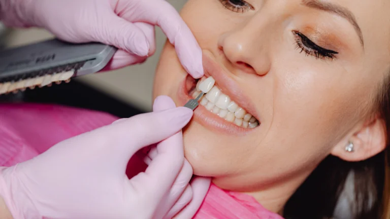Hollywood Smile: A Step-by-Step Guide to the Perfect Smile
