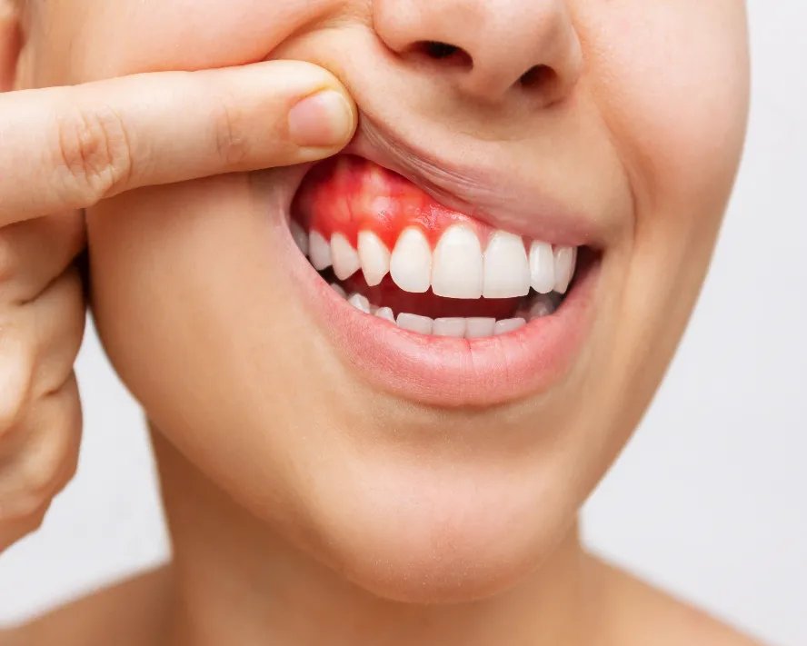 Periodoncia (tratamiento de las encías)