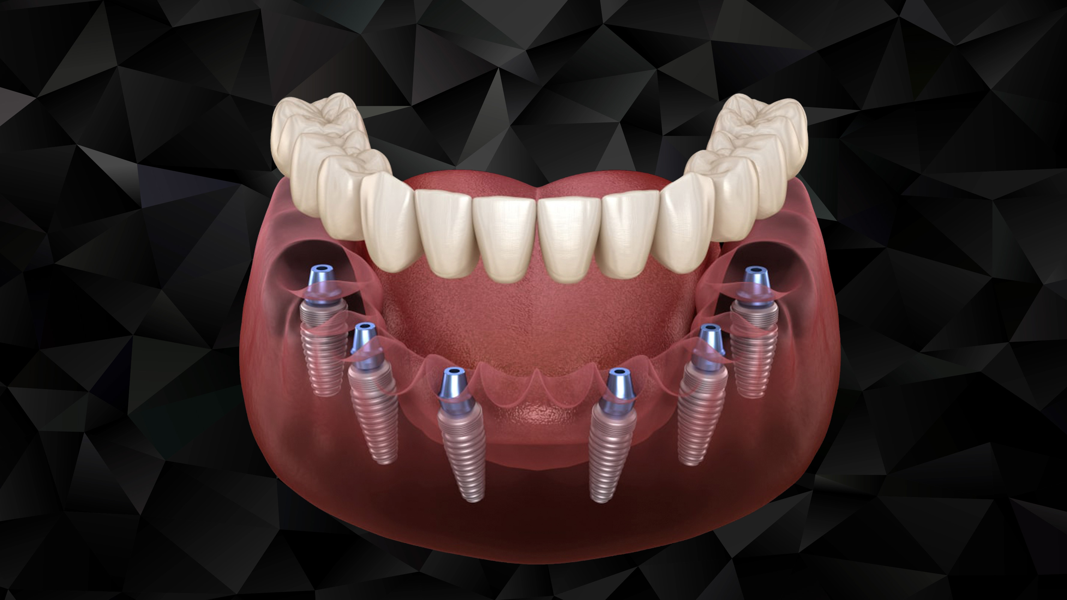 Имплантация зубов all on 6. Имплантация Neodent. Металлопластмассовый несъемный протез на 6 имплантах. Аллон 4 протезирование.