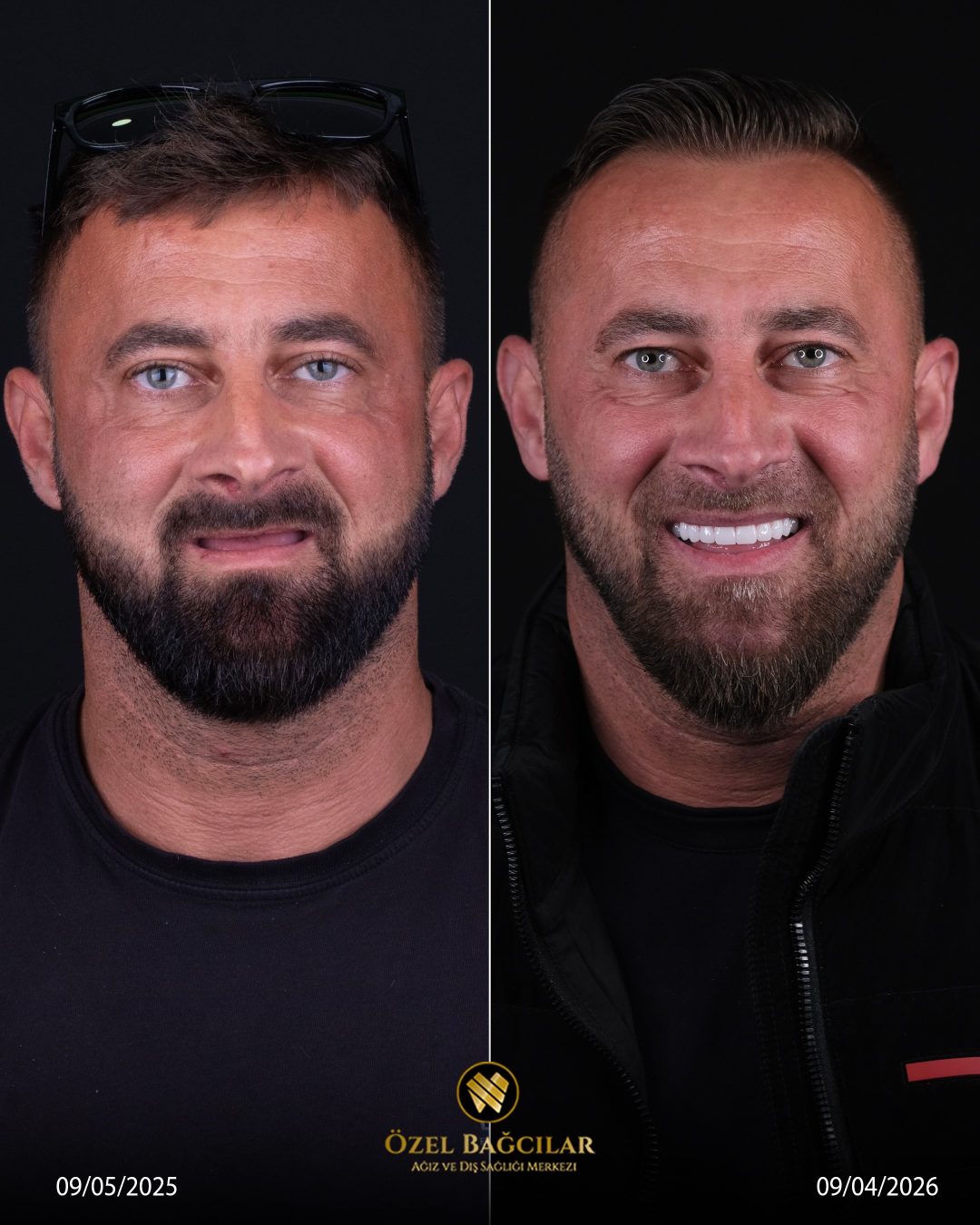 Bağcılar Diş öncesi sonrası