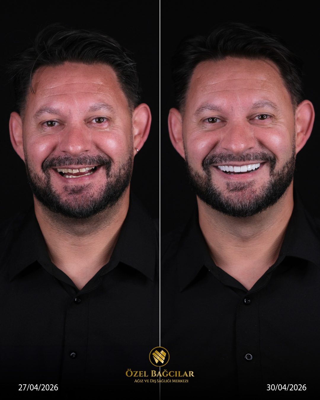 Bağcılar Diş öncesi sonrası