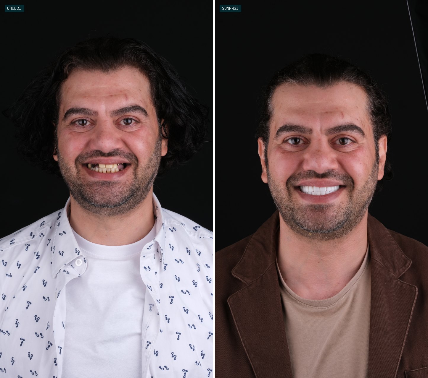 Bağcılar Diş öncesi sonrası